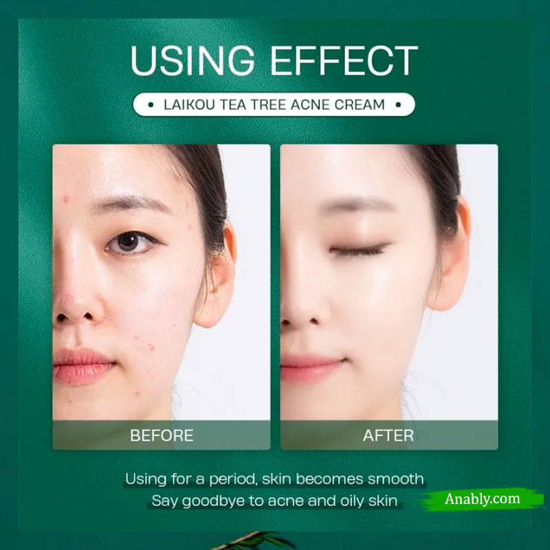 LAIKOU Tea Tree Acne Cream 20g - Unveil Radiant Skin Confidence