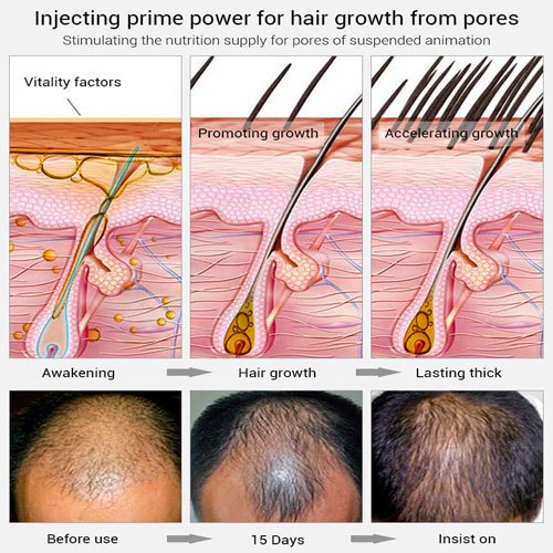 LANBENA Hair Growth Essence Spray - Boost Hair Growth at Best Price