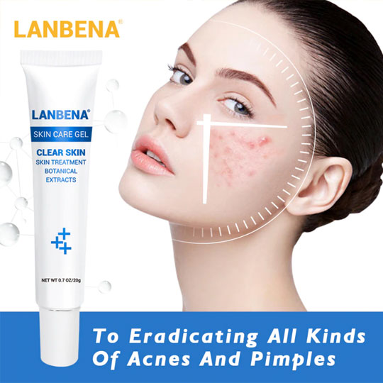Lanbena Acne Treatment Gel Acne Cleaning Blackhead Remover Acne Spots 0